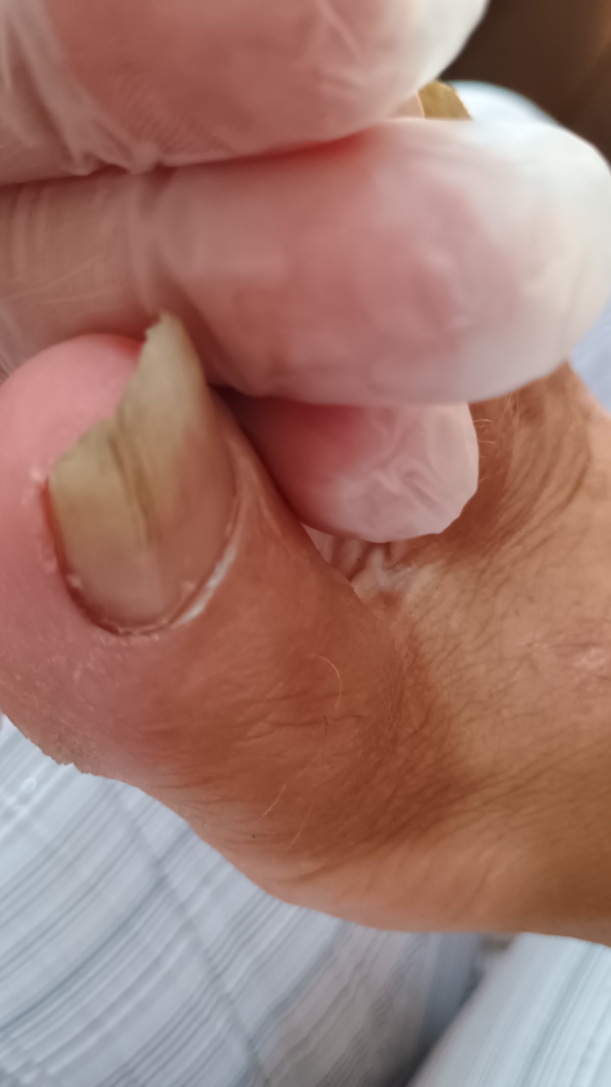 Medicinski pedikir - 1